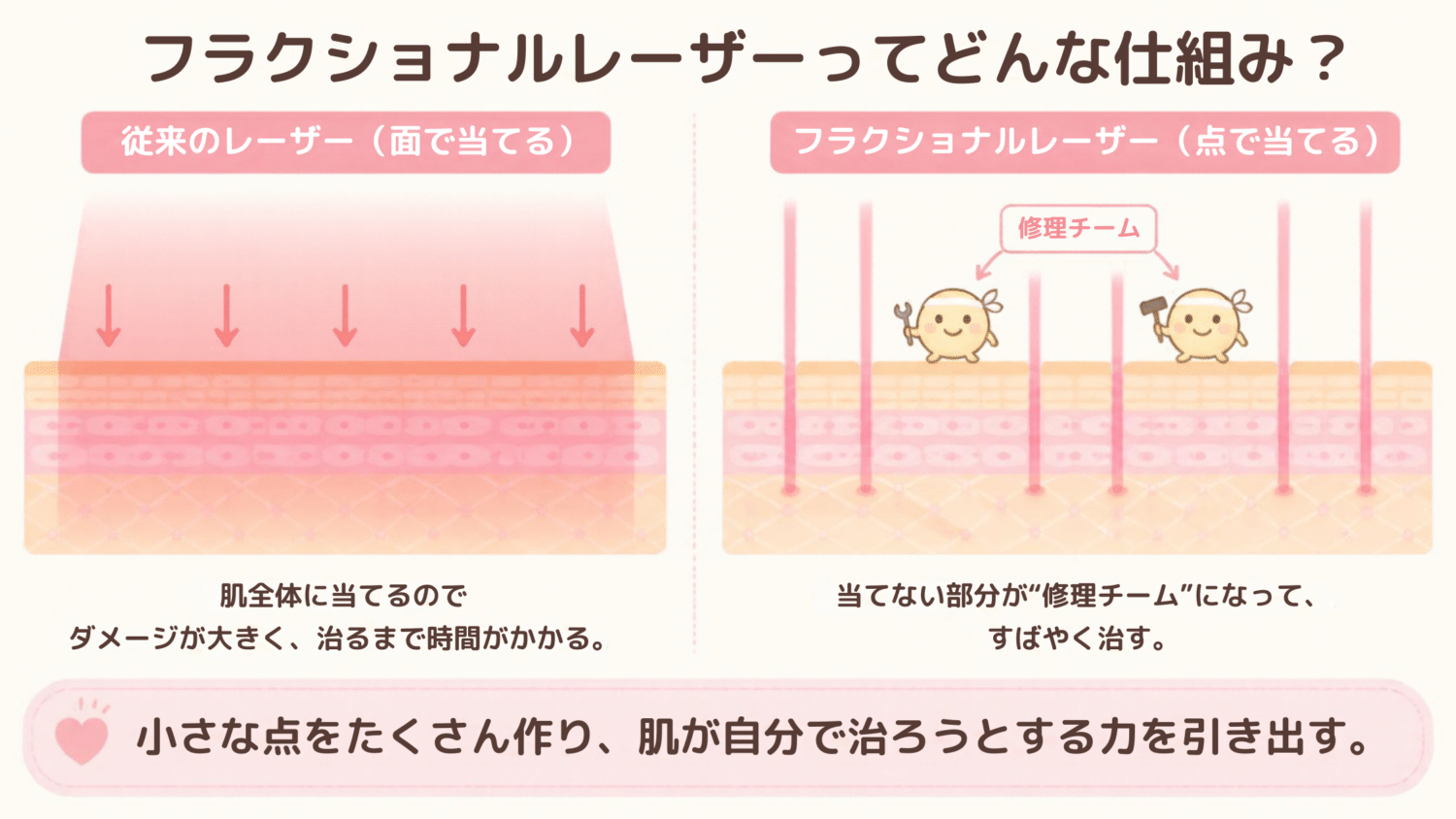 フラクショナルレーザーの仕組み図解